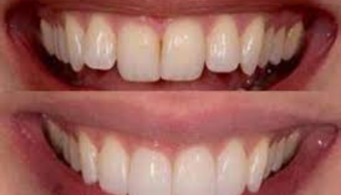 how to whiten veneers teeth